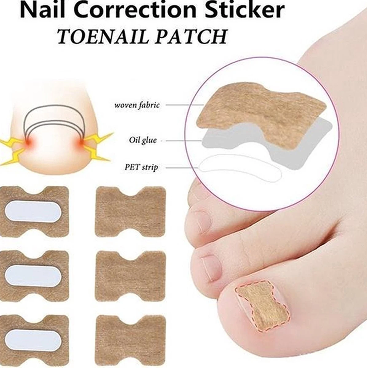 Teennagel Lifter I Ingegroeide Teennagel Corrector I Teennagel Pleister I Anti Ingroei Pleister I Nagel Correctie Kit I 30 Stuk