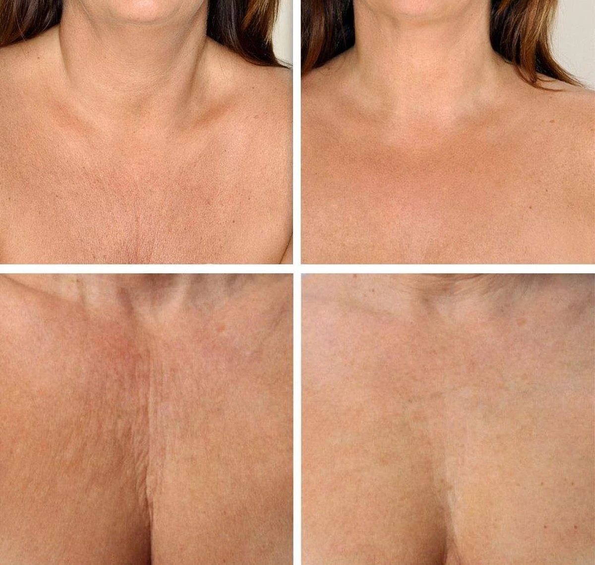 Simia™ Anti Rimpel Beauty Pads - Decolleté Large T Shape Set (2 Stuks) - Herbruikbaar Anti Aging Siliconen Pad Tegen Lijntjes En Slaaprimpels - Afbeelding 4