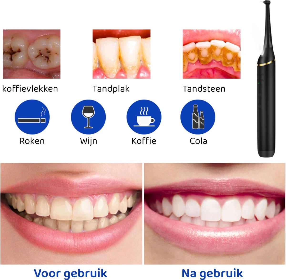 ExCorn Elektrische Tandsteen Verwijderaar - Inclusief 6-delig Tandartsset - 3 Standen - Elektrisch Tandplak Verwijderen - Tanden Polijsten - Afbeelding 4