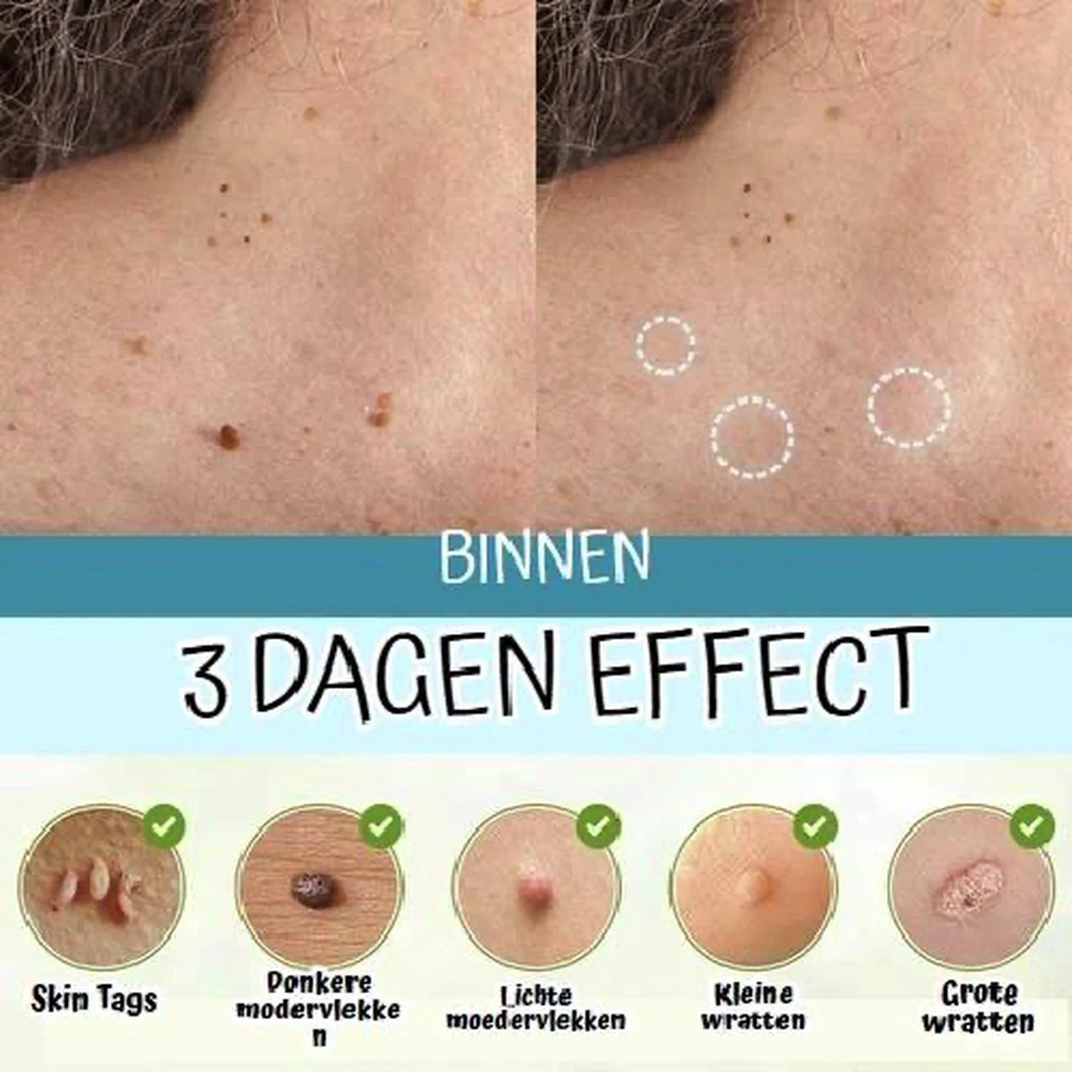 Skini™ - Moedervlekken & Wratten & Skin Tags Verwijderaar | Moedervlekken Verwijderaar | Wratten Verwijderaar | Moedervlekken Verwijderen | Wratten Verwijderen | Fibroom Verwijderen | Skin Tag Verwijderen | Steelwratjes Verwijderen - Afbeelding 3