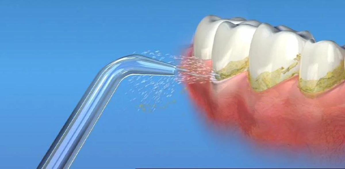 Waterpik JT-100 - Jet Tips - Opzetstuk Voor Waterflossers - 2 Stuks - Zilver - Afbeelding 4