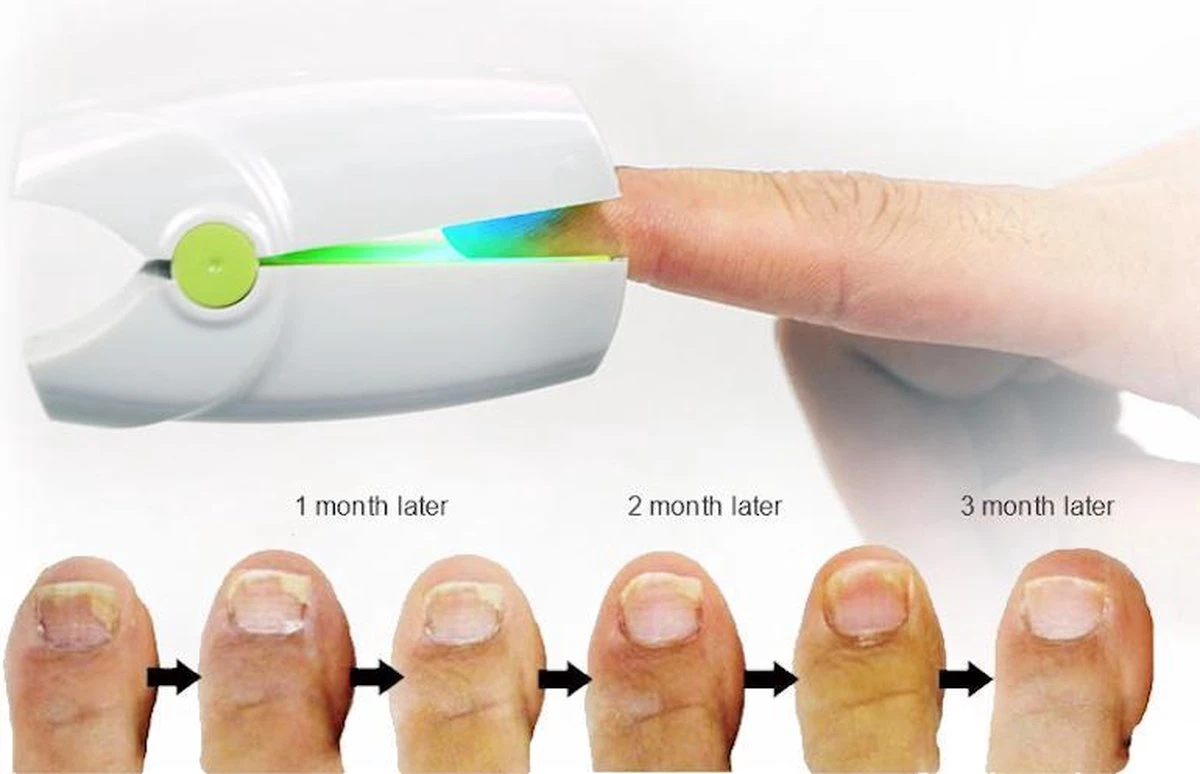 Anti Schimmelnagel Kalknagel Laserapparaat Om Zelf Te Behandelen, Veilig, Effectief, Snel En Pijnloos, Koude Laser Behandeling Voor Thuisgebruik, Voor Tenen En Vingers. Oplaadbaar. - Afbeelding 3